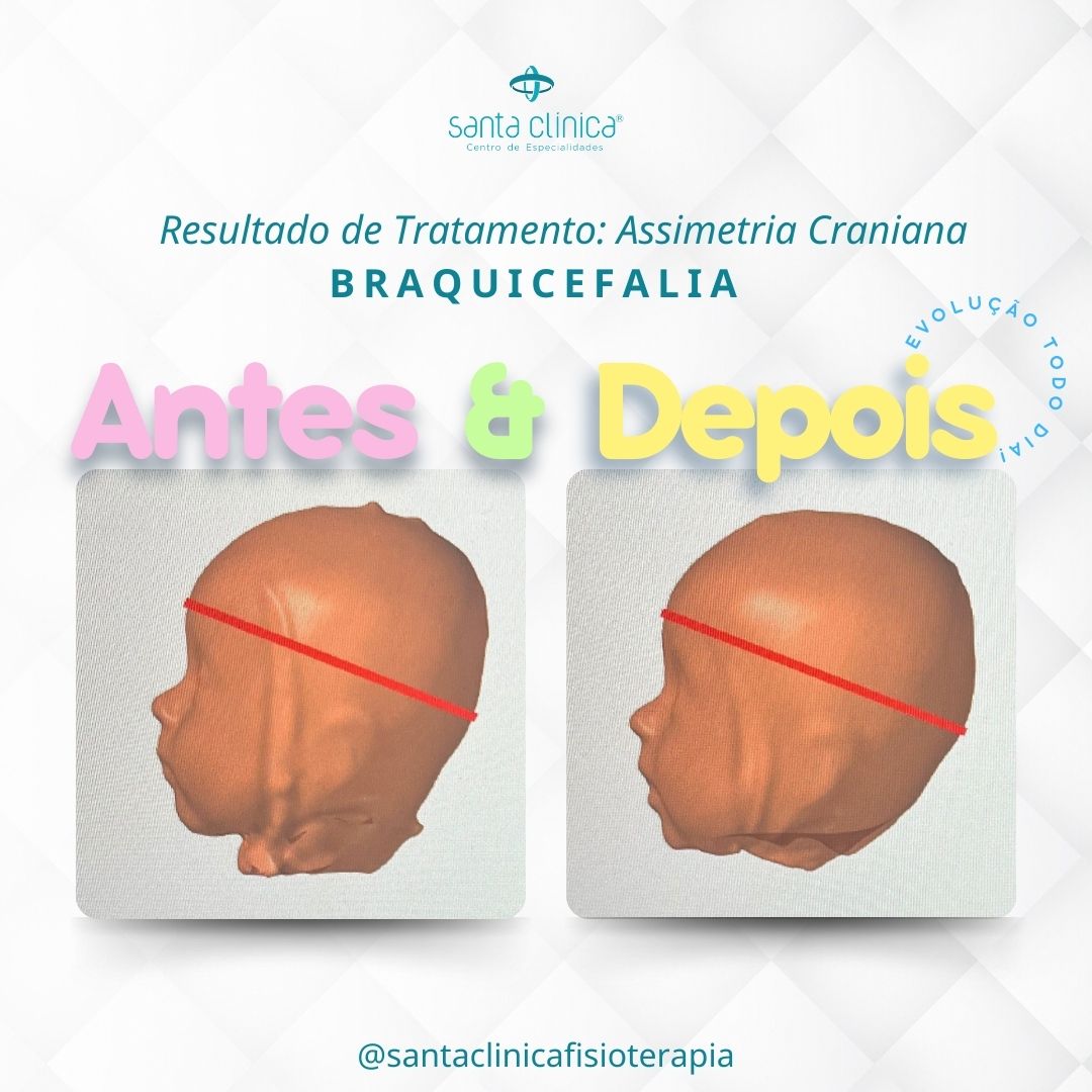 ANTES E DEPOIS: BRAQUICEFALIA