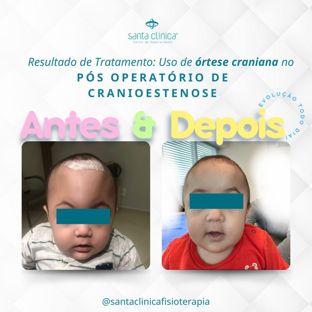 RESULTADO DE TRATAMENTO: USO DE ÓRTESE CRANIANA EM PÓS OPERATÓRIO DE CRANIOESTENOSE